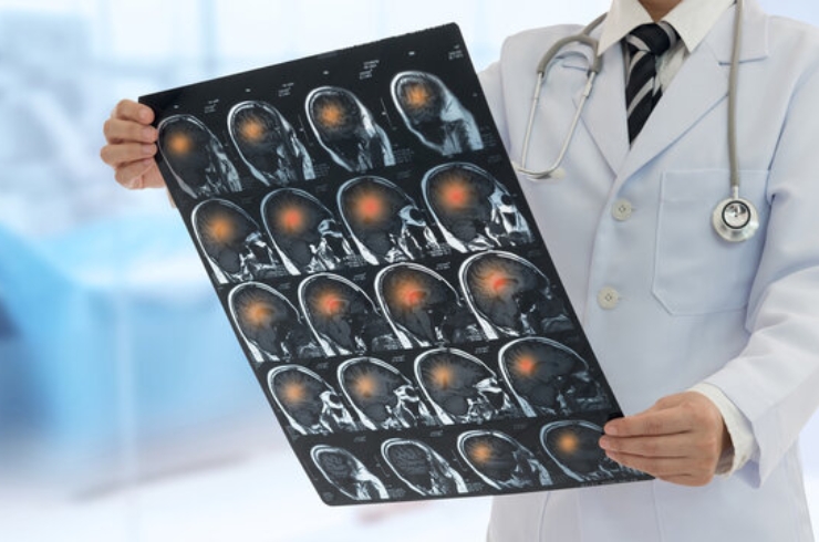 Vascular Neurosurgery (Aneurysms, AVMs)-----28